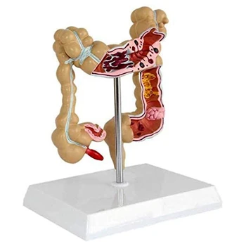Модел болестно колоректален рак на дебелото черво Модел анатомични модели на стомашно-чревния тракт
